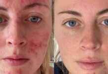 birmingham-live-best-dermatologist-approved-anti-blemish-serum-for-boosting-confidence