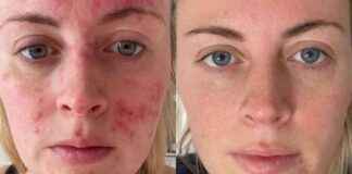 Birmingham Live: Best Dermatologist-Approved Anti-Blemish Serum for Boosting Confidence birmingham-live-best-dermatologist-approved-anti-blemish-serum-for-boosting-confidence